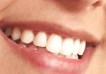 implantes-dentarios-maranguape-1377277683